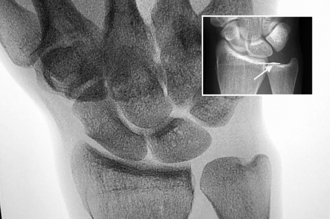 In this patient there is only slight positive ulnar variance (see insert & arrow) but  variance increases significantly with grip (large image).