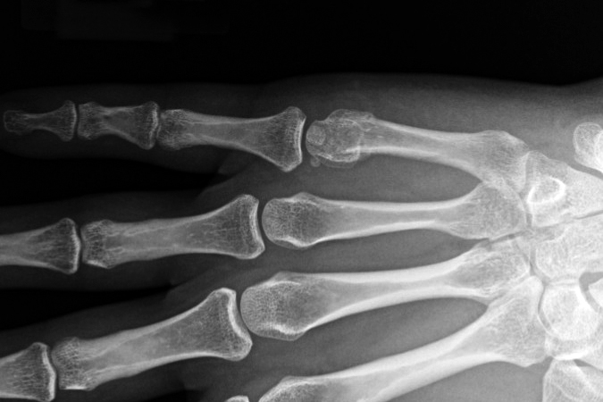 Boxer's fifth metacarpal neck fracture AP