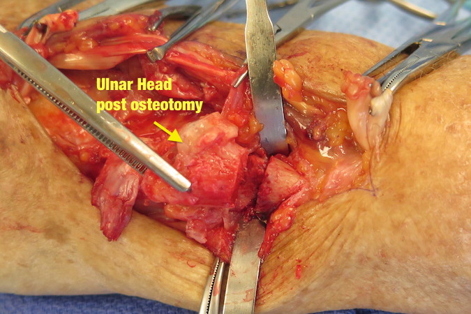 Ulnar head after osteotomy through the neck of the ulna.  Note proximal intact ulna still has attachments of the pronator quadrates attached to it.