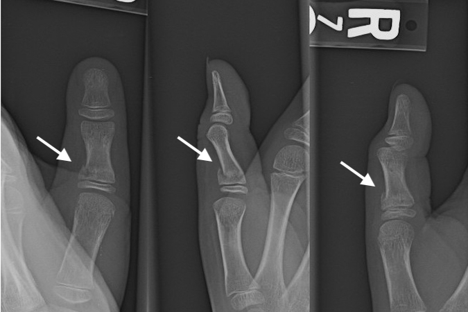 Thumb Proximal Phalanx Fracture Salter II (arrow) with minimal volar apex angulation.