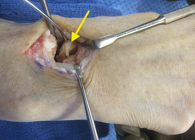 SNAC Wrist with arrow showing arthritic fragmented proximal scaphoid