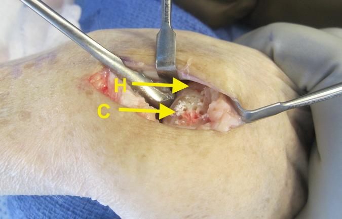 SNAC Wrist showing capitate and hamate being prepared for arthrodesis