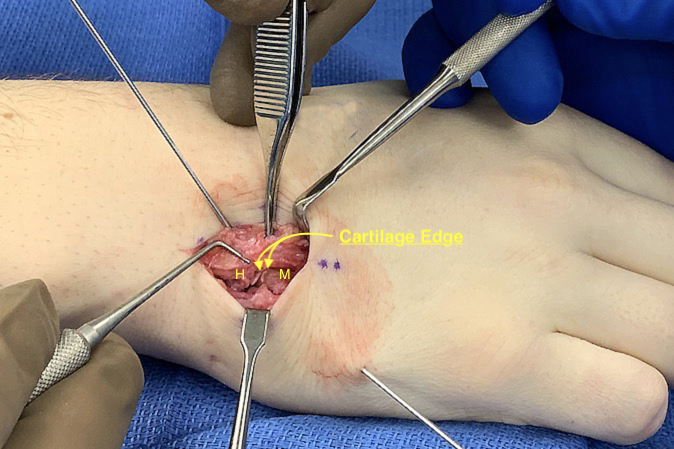 Fifth CMC joint fracture dislocation ORIF step 3 - Capsular closure about to begin after dislocation reduced and the pin in the comminuted dorsal hamate fragment is advanced into the metacarpal base. Anatomically reduced cartilage edges noted.  The retractor at the bottom of the photo is retracting the EDM and the dorsal ulnar sensory nerve.