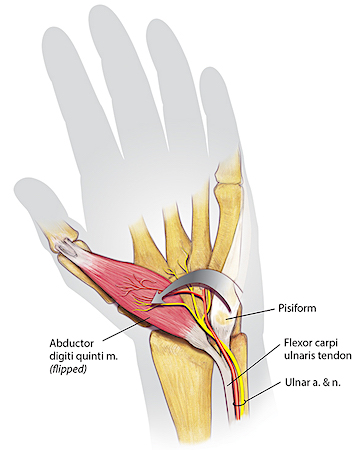 Huber opponensplasty - In step 2 the mobilized abductor digits minimi is brought through the subcutaneous tissues of the thenar eminence.  The detached distal abductor digiti minimi tendon is sutured to the abductor pollicis brevis insertion site.  The neurovascular bundle must be handled delicately in order to maintain the innervation and blood supply of the abductor digiti minimi.  This transfer supplies opposition and improved appearance of the thenar eminence by adding muscle bulk to the thenar area.