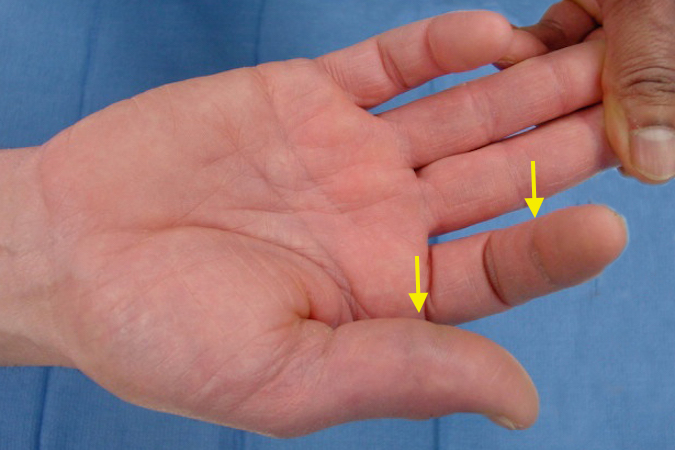 Note lack of index DIP and thumb IP flexion (arrows) in patient with Anterior Interosseous Nerve Palsy