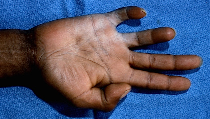 Ulnar Nerve Palsy with clawing of the fourth and fifth fingers and marked dryness of the ulnar denervated skin (anhydrous )