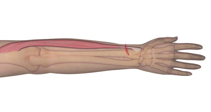 This illustration represents the anatomy of the muscle and tendon origin and insertion. Should an individual sustain a laceration as depicted, the observer can assume that the underlying tendon may be at risk for complete transection. A proper examination is needed to determine the integrity of the tendon.