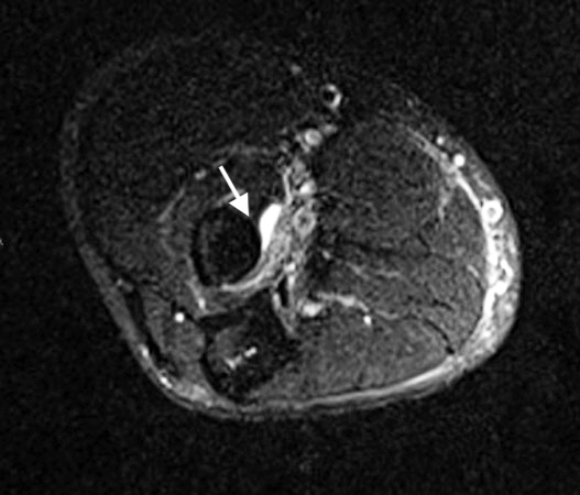 1.	This MRI (T2) cross-sectional image at the level of the elbow shows the radius and the insertion site of the biceps tendon on the radius tuberosity (arrow). The ruptured biceps tendon is not present. Edema (white) secondary to the biceps rupture is evident at the tuberosity.  The structures adjacent to the edema are the neurovascular bundle and surrounding fatty tissues.