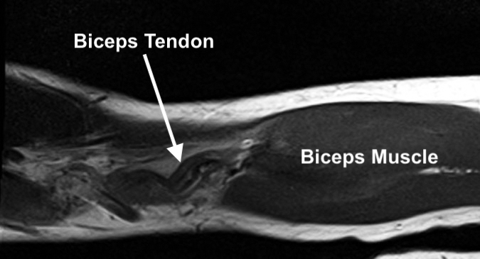 2.	This MRI (T1) image of the biceps is a coronal view.  The biceps muscle is visible, and the retracted curled up and ruptured biceps tendon is seen at the level of the elbow.  