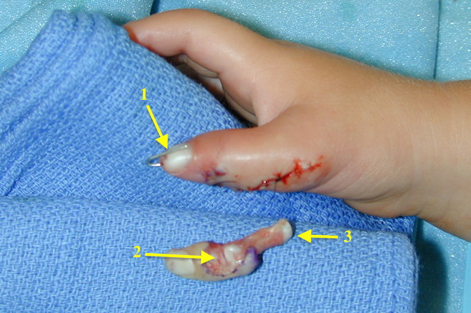 Bifid Thumb Right ( Wassel IV) dorsal view with K-wire stabilizing reconstructed collateral ligament. Note original radial EPL insertion site (2) and skeletanized proximal phalanx (3) because must radial tissue used to reconstruct the ulnar thumb.