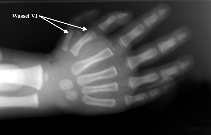 Bifid Thumb Right ( Wassel VI)