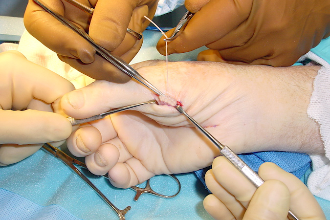 The EDM tendon is ready for suturing to the conjoin tendon of the AbP, FPB & Opponens.