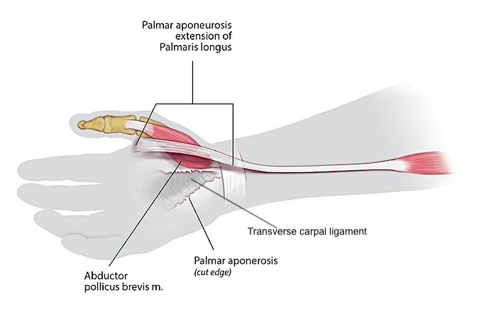 Camitz Transfer – Stage 1:  During an open carpal tunnel release, the distal end of the palmaris longus is identified and released from its forearm attachments while its connections to the palmar aponeurosis are left intact.  The palmar aponeurosis extension is dissected off the transverse carpal ligament and surrounding structures. 