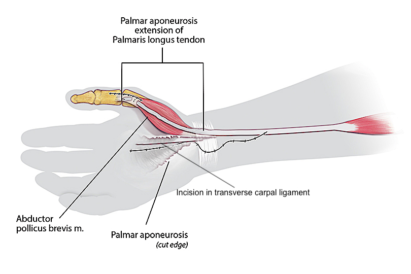 Camitz Transfer – Stage 2:  The open carpal tunnel release has been completed. The palmaris longus and the attached palmar aponeurosis (fascia) extension are passed subcutaneously superficial to the abductor muscle to abductor aponeurosis where it is sutured to the radial aspect of the extensor hood at the thumb MP joint level.  The skin incisions for releasing the palmaris longus, doing the carpal tunnel release and for suturing of the transfer to the extensor hood are sutured.