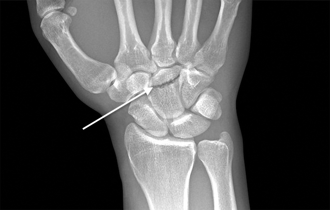 Fracture (arrow) of the dorsal lip of the capitate AP view