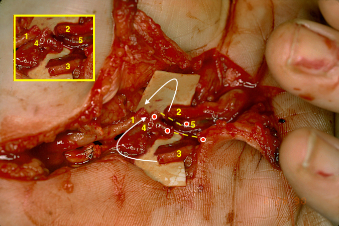 Insert show common digital nerve to the ring -little web(1); ulnar digital nerve to the ring finger(2); radial digital nerve to the little finger(3); common digital artery (4); ulnar digital artery to the ring finger (5); radial digital artery to little finger (red dot) under skin flap.  Arrows show planned microsurgical neurorrhaphies of the common digital nerve to the two digital nerves.