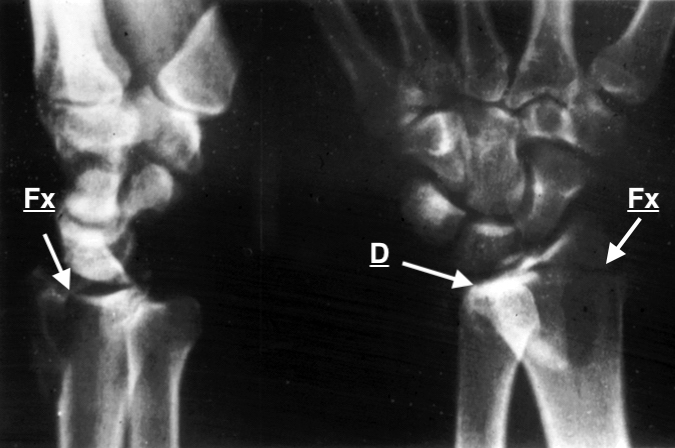 Volar distal radial ulnar joint dislocation (D) and distal radius fracture (Fx).  Note the overlap of the distal ulna on the distal radius in the AP view which is typical of a DRUJ volar dislocation.