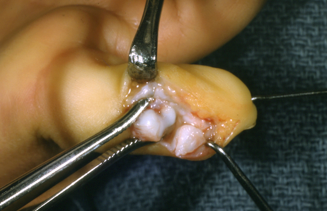 Surgical exposure of delta phalanx (arrow) left fifth finger