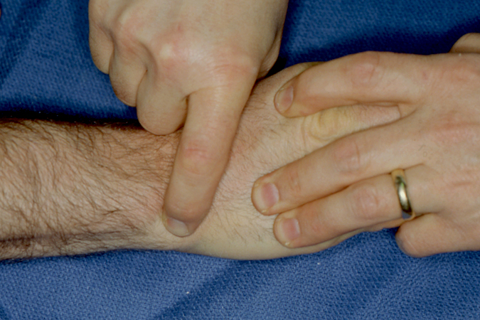 Tenderness with palpation of the ECU just distal to the ECU groove in the ulnar head