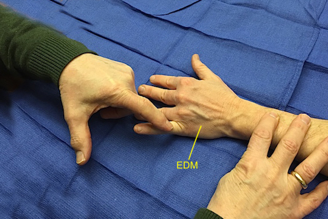 Before doing an EDM opponensplasty, test the muscle grade (strength) of the EDM.  A muscle testing grade of 5/5 (normal) is ideal for transfer.