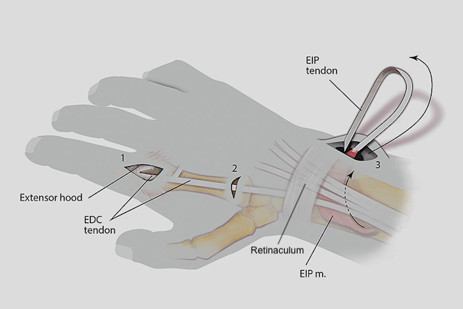 Step 2 EIP Opponensplasty: EIP (Extensor Indicis Proprius) is brought out of the fourth extensor compartment through the subcutaneous tissue with a tendon passer into incision 3. Next the EIP will be passed to incision 4 in the ulnar palm near the pisiform.