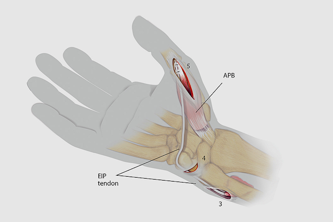 Step 3 EIP Opponensplasty: Once the EIP (Extensor Indicis Proprius) is brought into incision 4, a tendon passer retrieves the EIP at the 4th incision, brings the tendon distal to the pisiform, through the subcutaneous tissues to incision 5.  The EIP is then sutured into the conjoin tendon as shown.