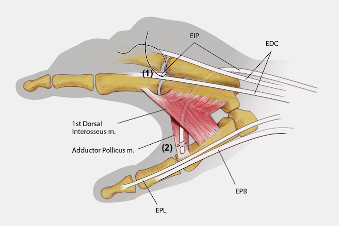 The extensor indicis (EIP) transfer to improve thumb abduction starts with an incision over the index MP joint and the ulnar aspect of the metacarpal neck.  The EIP is released from the extensor hood over the base of the index proximal phalanx. The defect at (1) is repaired. The EIP is passed subcutaneously and under the long EDC. Next a clamp is used to pass it through the III-IV metacarpal interspace and into the palm. The tendon and clamp are identified ulnar to the long metacarpal and flexor tendon shea