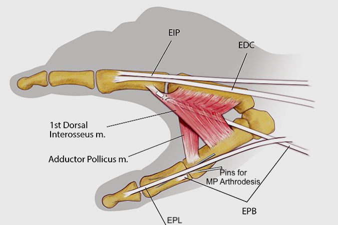 The EPB and Thumb MP arthrodesis pinch transfer as taught by Carroll begins with a longitudinal incision over the thumb MP joint. The capsule is opened and the EPB released from its capsular insertion and proximal soft tissue attachments. The cartilage is removed from the head of the metacarpal and proximal phalanx  and the collateral ligaments and volar plate released. A standard cone-in-cup arthrodesis is then performed and internally fixed with one or two  k-wires. Once the arthrodesis is completed, the 