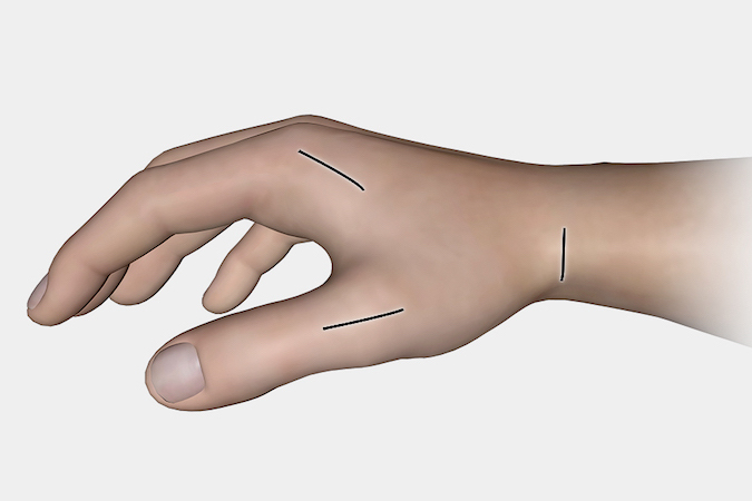 Incisions for EPB and Thumb MP arthrodesis pinch transfer 