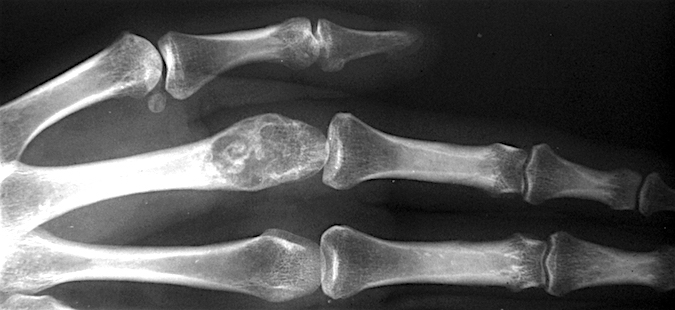 Enchondroma with cortical thinning and index metacarpal head expansion