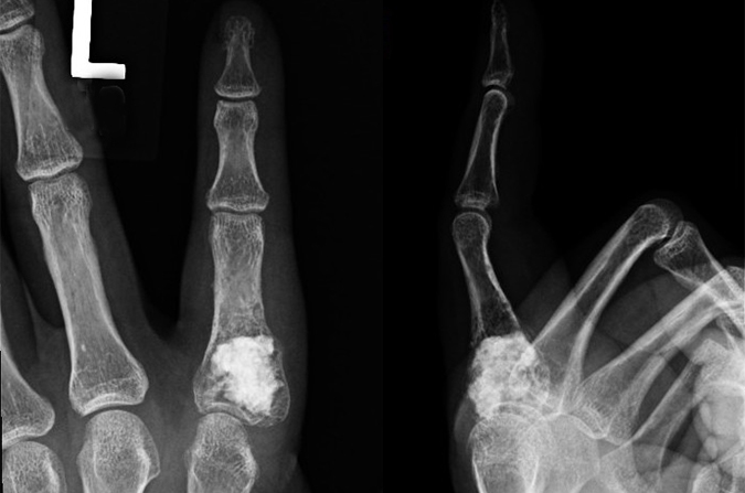 Enchondroma after curettage and grafting with allograft