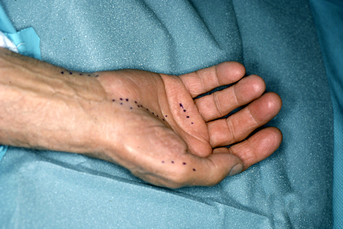 Incisions for FDS IV Opponensplasty and carpal tunnel release