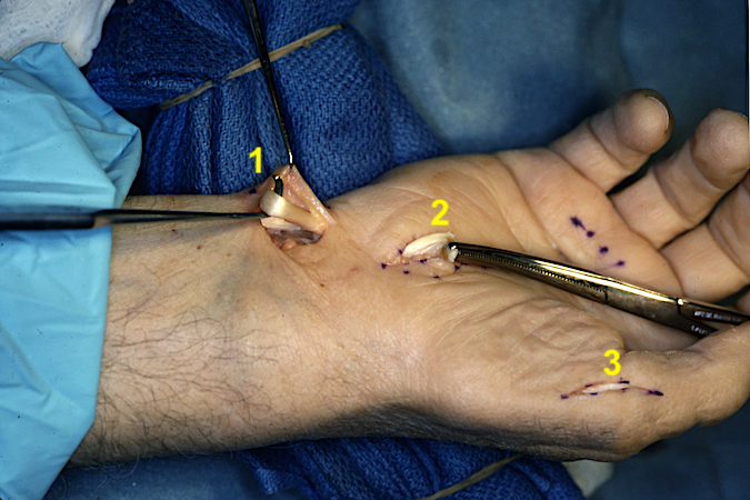 FDS IV Opponensplasty & CTR. FDS passed around the FCU (1) which serves as a pulley. FDS passed subcutaneously to CT incision (2). Next FDS will be passed subcutaneously to radial side of the thumb MP joint (3) and sutured to the conjoined tendon. 