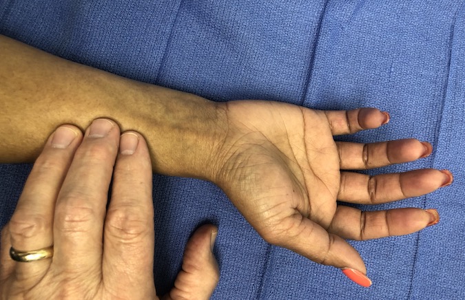 Pressure on the relaxed flexor pollicis muscle can produce passive thumb IP joint flexion indicating that the FPL tendon is intact.