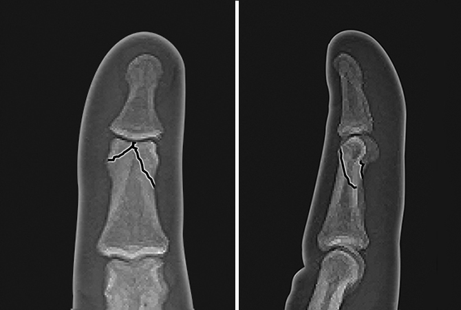 Non-displaced bicondylar middle phalanx neck fracture