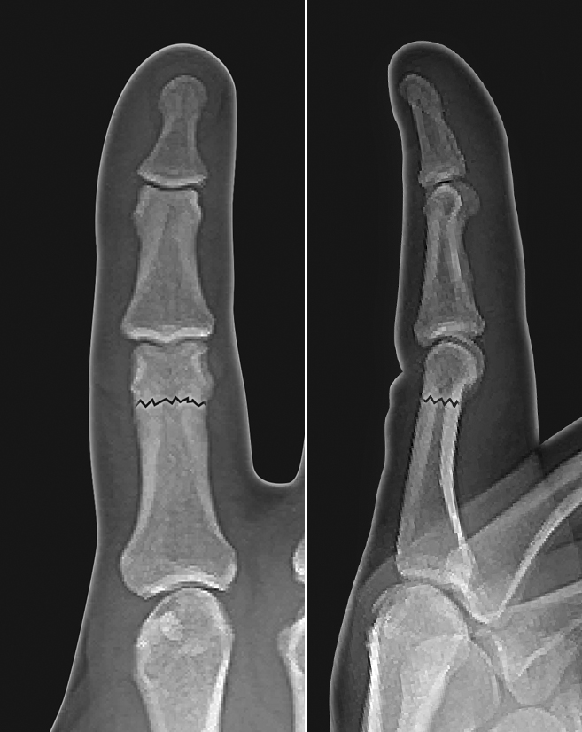 Non-displaced proximal phalanx neck fracture