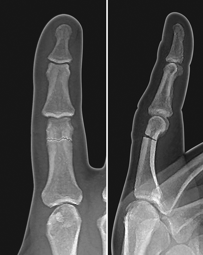 Angulated proximal phalanx neck fracture