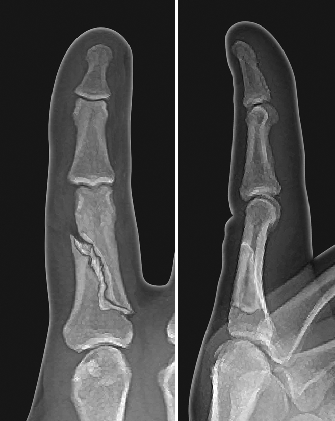 Displaced spiral proximal phalanx shaft fracture