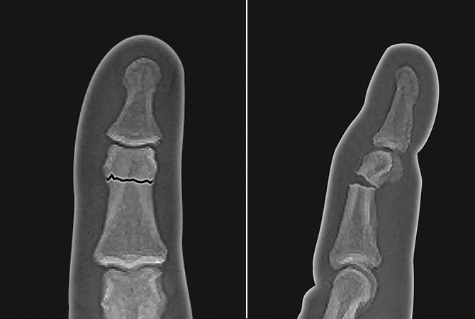 Angulated middle phalanx neck fracture