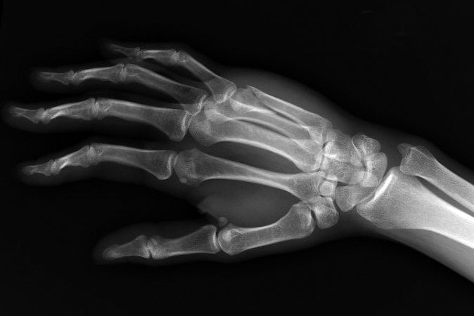 Fifth metacarpal neck/head spiral oblique displaced articular fracture  Oblique.