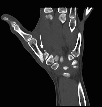 CT of classic Bennett's Fracture (arrow)