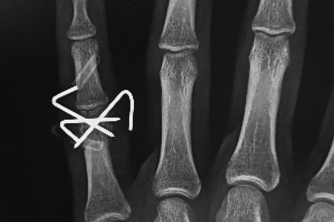 Little finger proximal phalanx bicondylar fracture after closed reduction and pinning AP