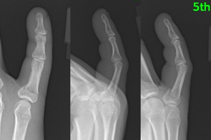 Proximal phalanx base fracture, base non-angulated with mild shortening