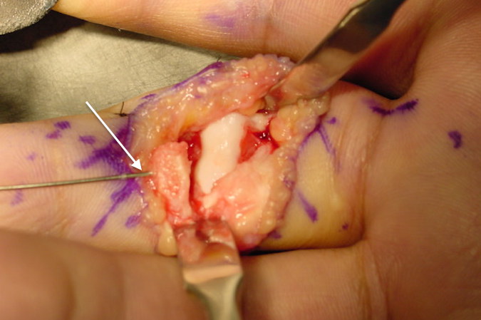 Arrow on temporary fixation K-wire in fracture fragment