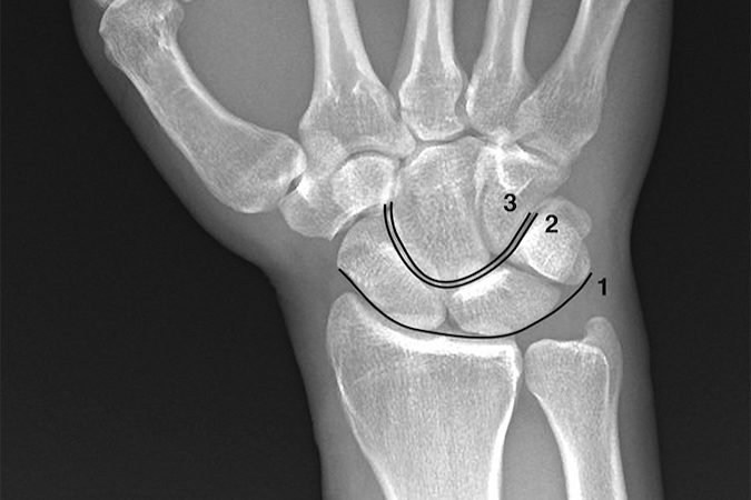 Gilula’s lines (ref 2) superimposed on a neutral deviation PA wrist x-ray. Arc 1 is a smooth arcing line paralleling the proximal articular surfaces of the triquetrum, lunate, and scaphoid. Arc 2 parallels the distal concave surfaces of the triquetrum, lunate, and scaphoid. Arc 3 parallels the smooth curved surface of the proximal hamate and capitate. When these smooth curved lines are irregular, disrupted, or step off it is indicative of a carpal instability or dislocation.