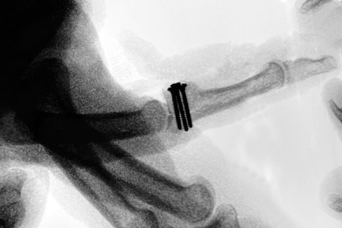 Lateral X Ray of the finger after internal fixation of the hemi-hamate graft.