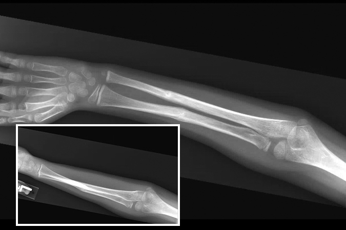 FRACTURE RADIUS AND/OR ULNA AND/OR BOTH FOREARM BONES PEDIATRIC | Hand ...