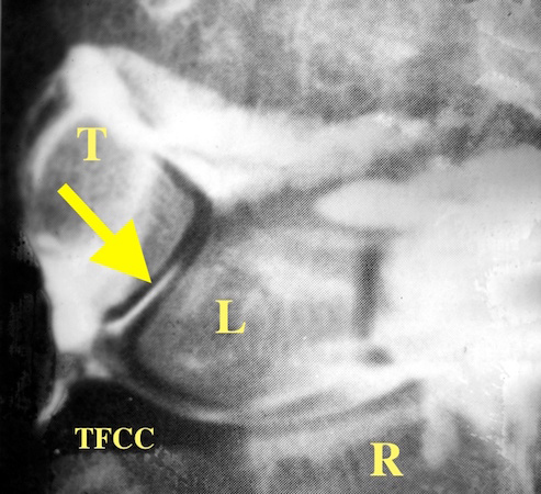 Wrist arthrogram consisted with a torn L-T ligament.