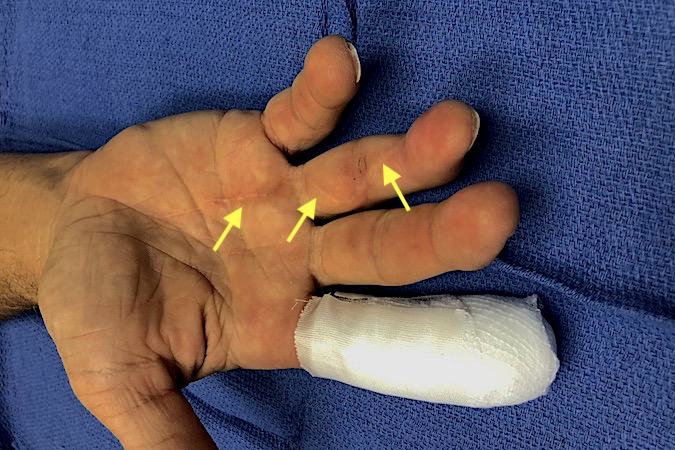 Lumbrical Plus Finger : Patient presents for simple index laceration who had serious injury to III,IV&V several years ago that required  tendon graft (IV). Note old incisions (arrows).  Now patient complains ring straightens when he tries to flex it.