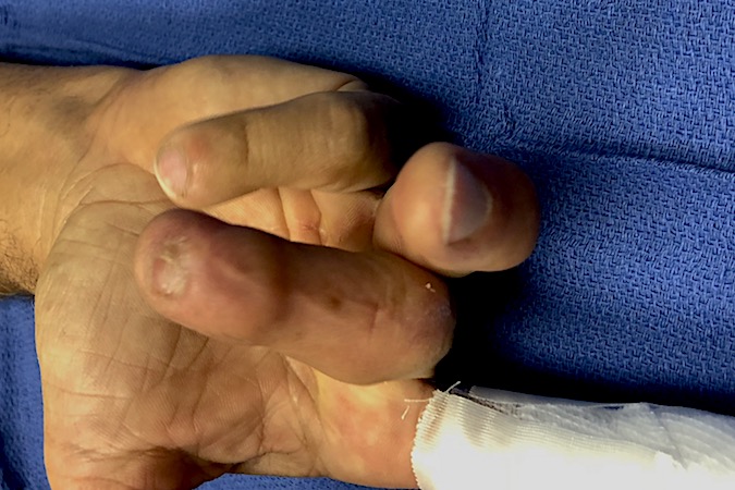 Lumbrical Plus finger : Patient presents for simple index laceration who had serious injury to III,IV&V several years ago that required  tendon graft (IV). Now patient complains ring straightens when he tries to flex it.